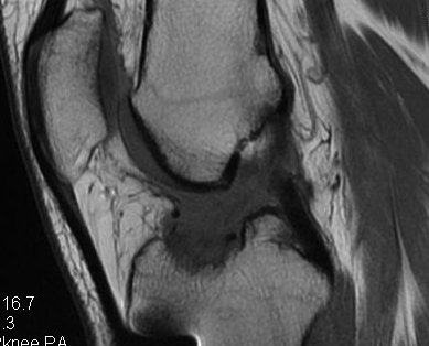 Revision ACL Ruptured Graft MRI BPTB Allograft